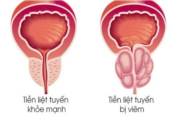 Những Ảnh Hưởng Của Viêm Tuyến Tiền Liệt
