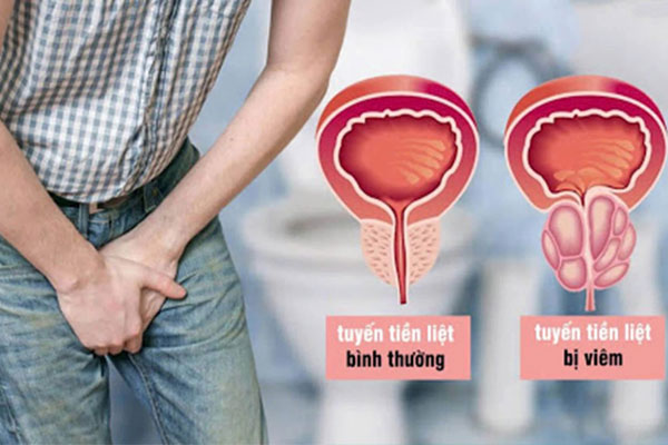 Dấu Hiệu Nhận Biết Viêm Tuyến Tiền Liệt