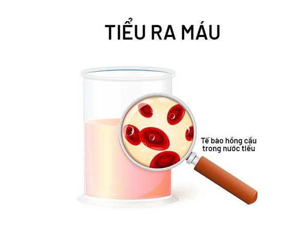 Đi Tiểu Ra Máu, Nguyên Nhân, Dấu Hiệu Và Cách Chữa Trị Hiệu Quả