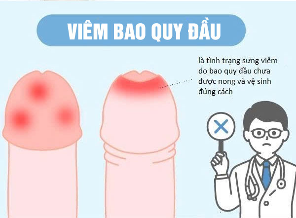 Dấu hiệu viêm bao quy đầu cần chữa ngay