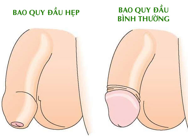 Nguyên Nhân Hẹp Bao Quy Đầu Ở Nam