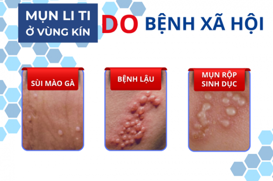 Nổi Mụn Li Ti Ở Vùng Kín Nữ Là Bị Gì?