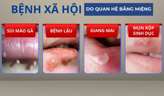 Quan Hệ Tình Dục Bằng Miệng Có Lây Bệnh Xã Hội Không?