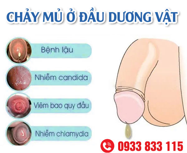 Chảy Mủ Bao Quy Đầu