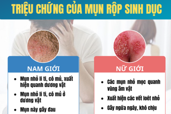 Nhận Diện Mọi Dấu Hiệu Mụn Rộp Sinh Dục