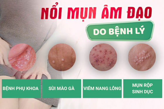 Nổi Mụn Âm Đạo Là Triệu Chứng Bệnh Gì?