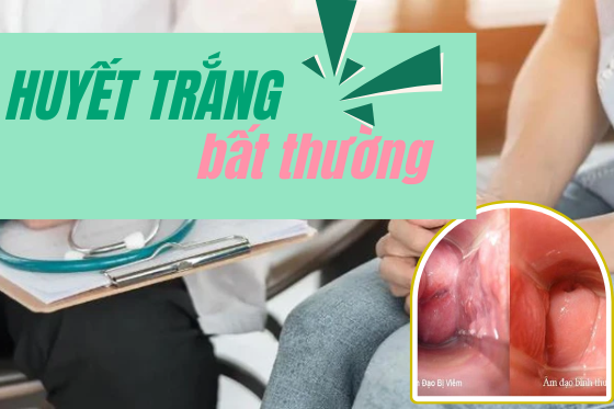 Tìm Hiểu Về Huyết Trắng Thường Gặp Phải Ở Chị Em