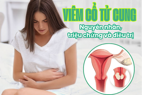 Viêm Cổ Tử Cung: Nguyên Nhân, Triệu Chứng Và Điều Trị