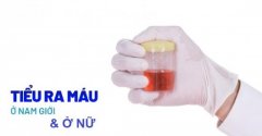 Đi Tiểu Ra Máu, Nguyên Nhân, Dấu Hiệu Và Cách Chữa Trị Hiệu Quả