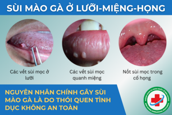 Tìm hiểu bệnh sùi mào gà ở lưỡi, miệng, họng