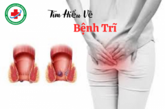Nhận Biết Về Bệnh Trĩ - Các Triệu Chứng Bệnh Trĩ Gây Ảnh Hưởng Sức Khỏe