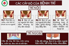 Nhận Biết Các Cấp Độ Của Bệnh Trĩ 