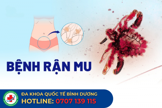 Bệnh rận mu: Nguyên nhân, dấu hiệu, điều trị.