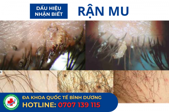 DAU-HIEU-RAN-MU.png