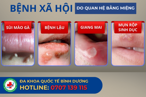Quan hệ tình dục bằng miệng có lây bệnh xã hội không?