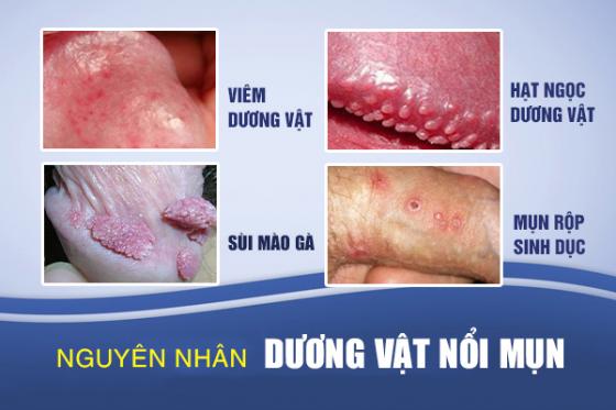 mun-duong-vat-1.jpg