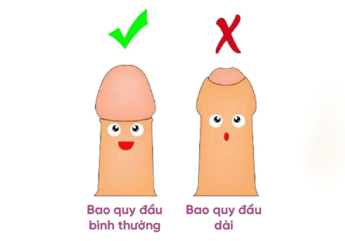 Cách Điều Trị Dài Bao Quy Đầu An Toàn Hiệu Quả Hiện Nay