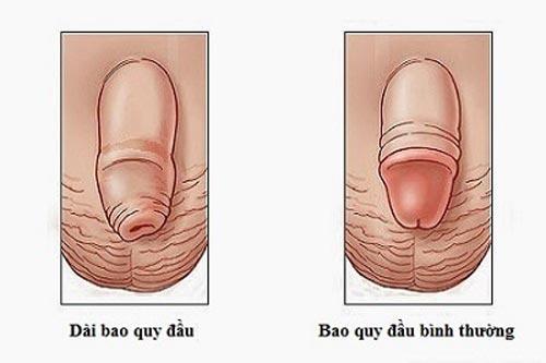 Nguyên Nhân Dài Bao Quy Đầu Là Gì?