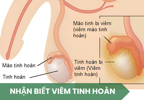 Cách Nhận Biết Viêm Tinh Hoàn Sớm