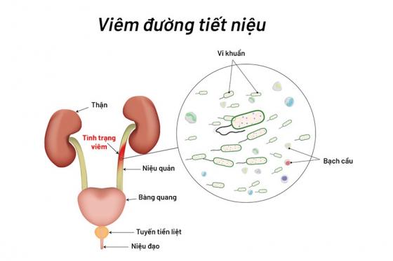 mo-ta-viem-duong-tiet-nieu.jpg