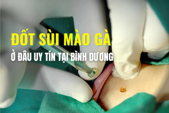 Đốt Sùi Mào Gà Chi Phí Tiết Kiệm Tại Bình Dương