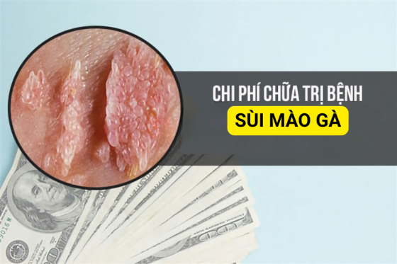 Chi Phí Khám Chữa Sùi Mào Gà Bao Nhiêu?