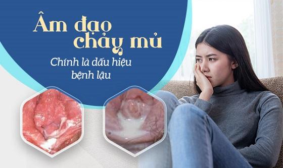 am-dao-chay-mu-bieu-hien-canh-bao-benh-lau-o-nu.jpg