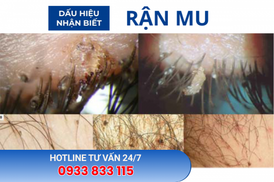Bệnh Rận Mu: Nguyên Nhân, Dấu Hiệu, Điều Trị
